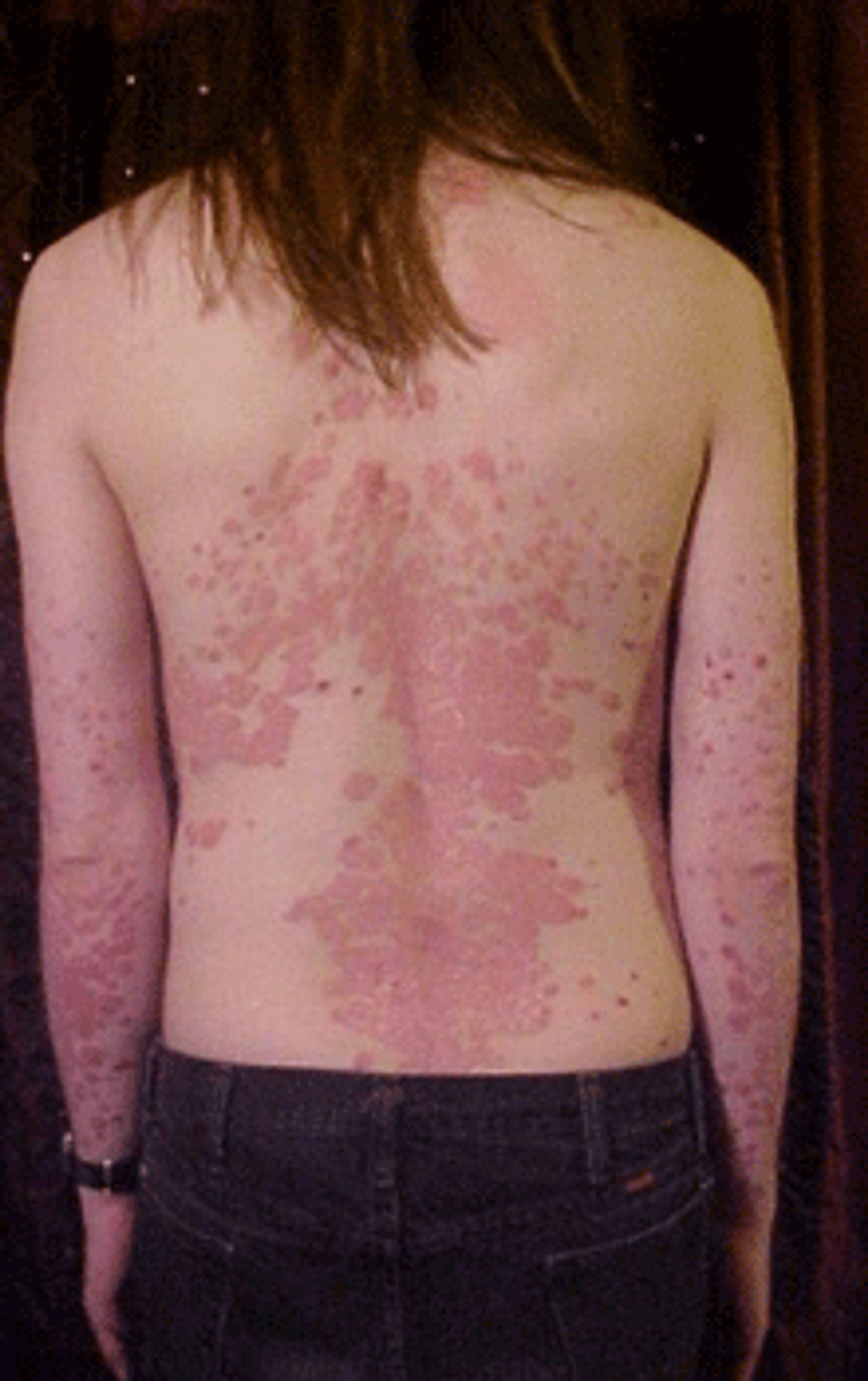 Psoriases kan variere helt fra det sm� og plagsomme til det sv�rt brutale og smertefulle p� kroppen. Foto: Wikipedia.com