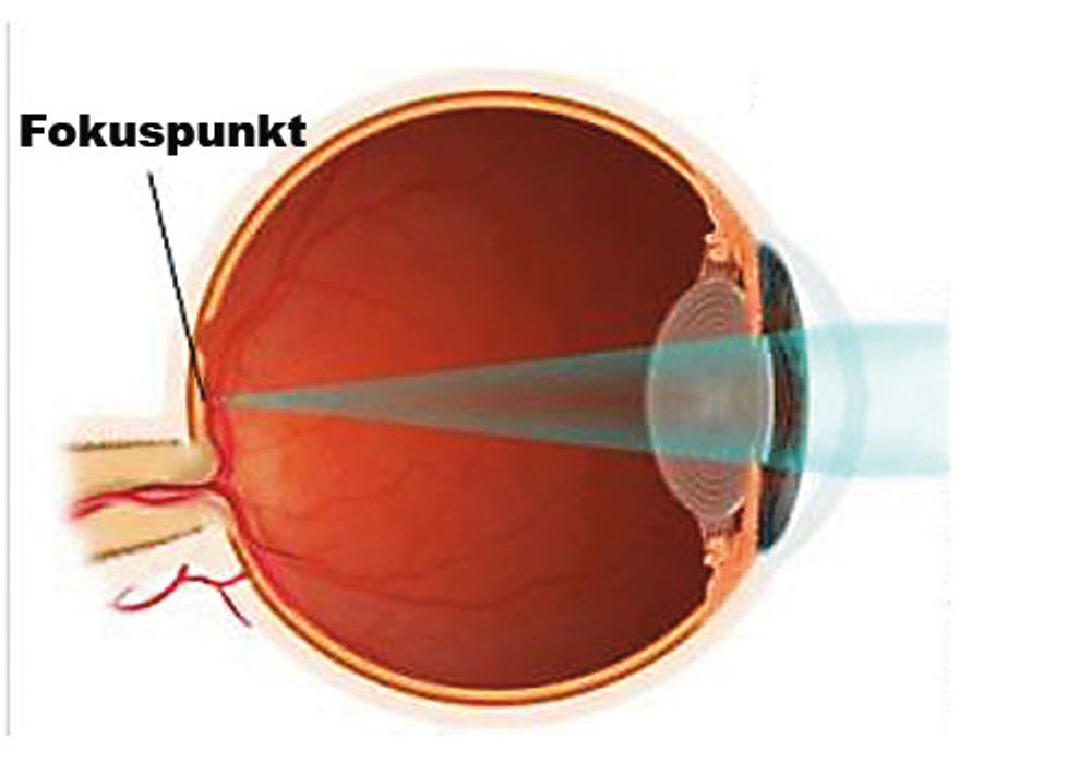 I et øye uten synsfeil faller fokuspunktet direkte på øyets netthinne, og vi ser skarpt. Så lenge linsen er fleksibel, vil den endre krumning slik at bildet faller direkte på øyets netthinne, avhengig av hvilken avstand vi ser på.