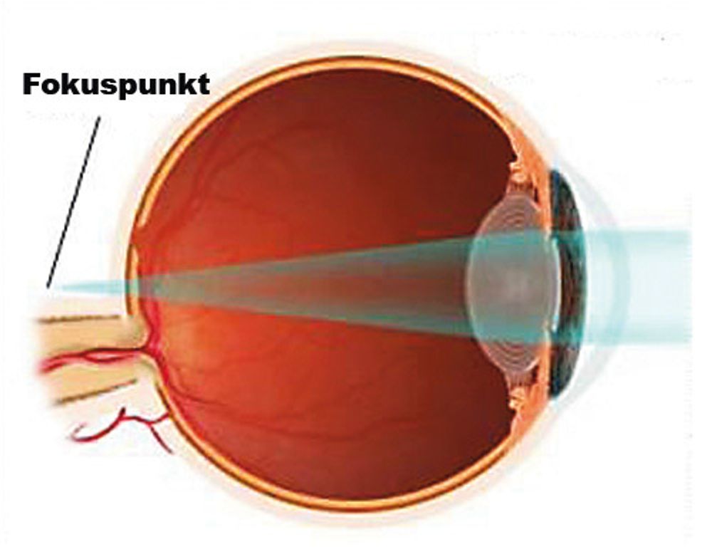 Ved presbyopi faller fokuspunktet bak netthinnen. Linsen mister gradvis sin fleksibilitet, og klarer ikke lenger å endre krumning slik at fokuspunktet faller direkte på netthinnen. Da er det behov for briller, linser eller intraokulær linse for å få fokus tilbake på øyets netthinne.