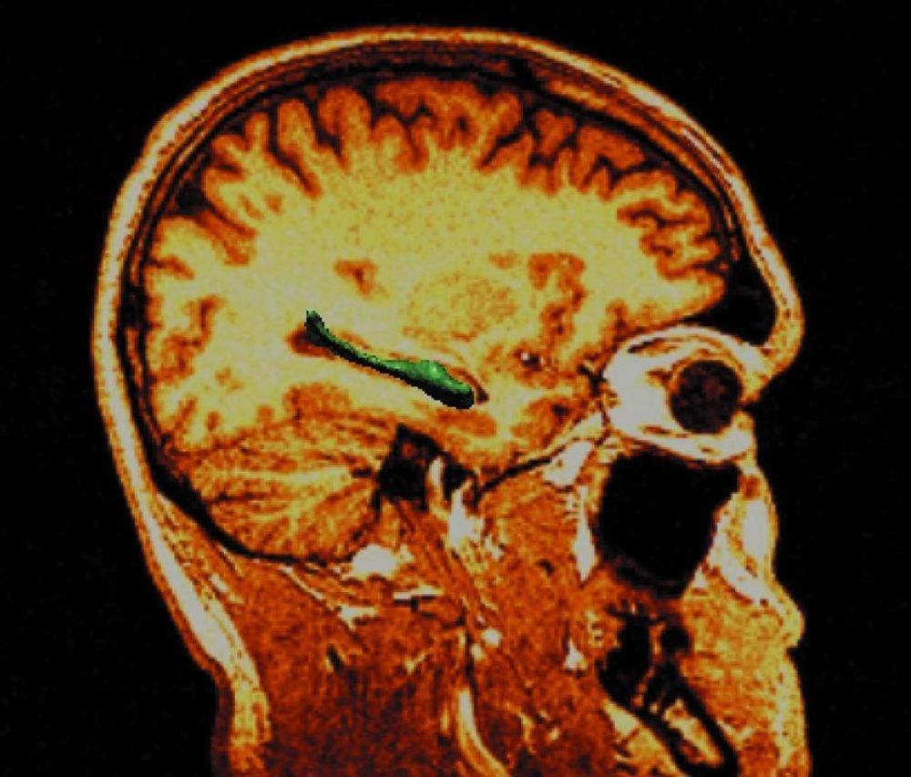 VIKTIG DEL: Kanskje ligger årsaken til autisme i mutasjoner som påvirker nervecellenes utvikling i hippocampusen (merket grønn).