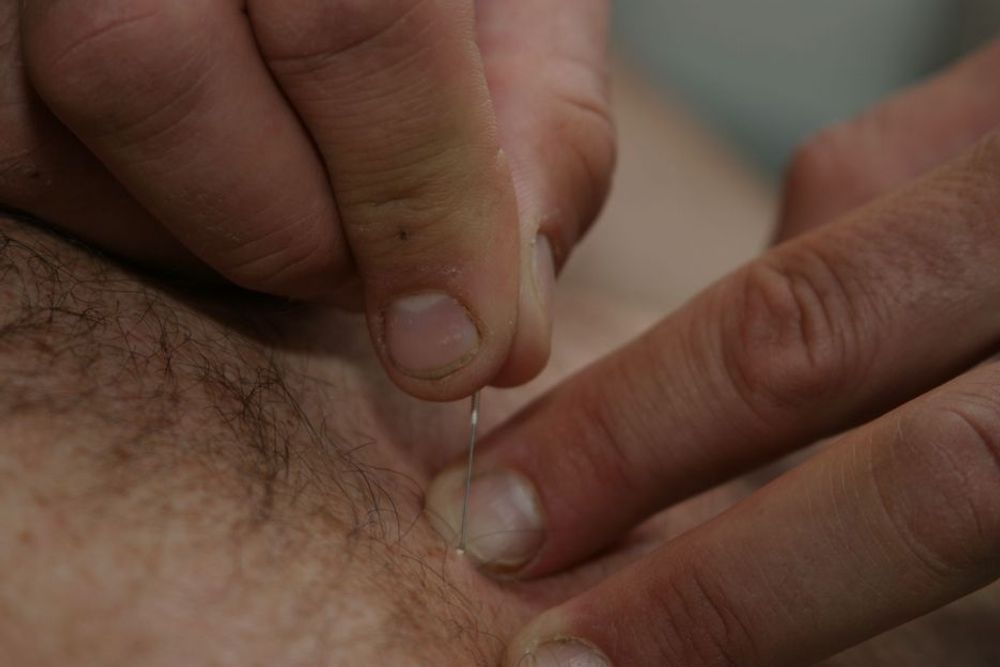 STIKK DEN: Med slike nåler utfører fysioterapeut og manuellterapeut Peter Døving Dry needles eller intermuskulær stimulering. Hensikten er å lade ut krampetilstander i muskulaturen.