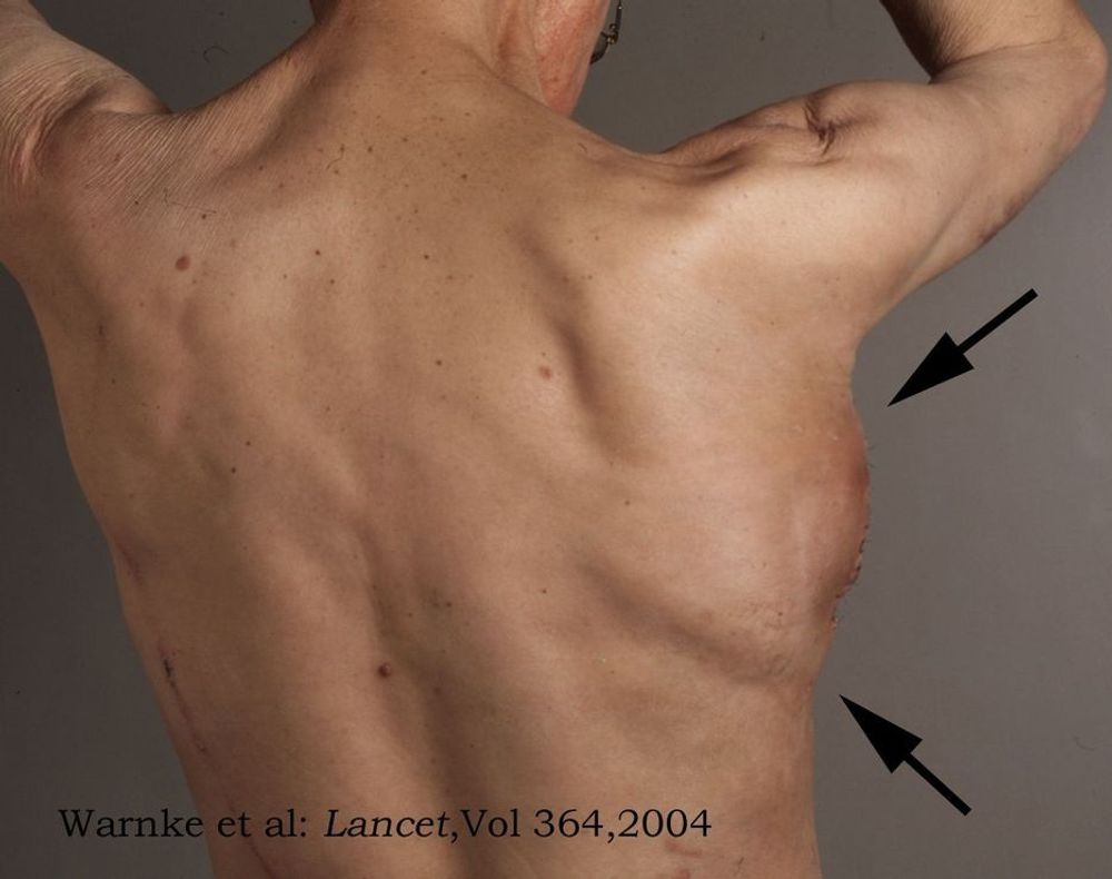 DYRKET PÅ RYGGEN: Kjeven ble operert inn i pasientens ryggmuskel for å gro før den ble operert inn i kjeven. Bildene ble først publisert i det britiske medisintidsskriftet Lancet.