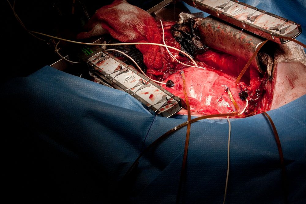 Koblet til hjertet: Kirurgene har plassert sensorene både utenpå hjertet og inne i hjertemuskelen. Målingene skal gjøre både ved åpen og lukket brystkasse for å teste hvorledes signalene endrer seg når brysthulen lukkes. 