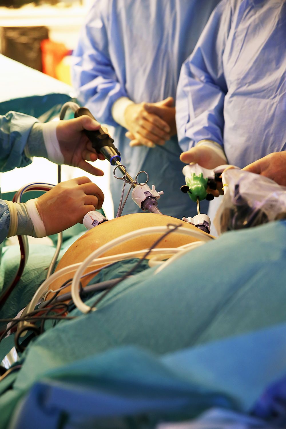 Kikkhull: Kirurgene fører kamera og operasjonsutstyr gjennom de fire hullene på magen til pasienten.