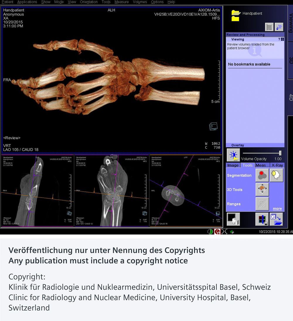 Tredimensjonalt: Sammen med en datamaskin kan bildene fra den nye robotrøntgenmaskinen lage svært detaljerte tredimensjonale bilder av skjelettet. Konvensjonelle 2D røntgenbilder vil ikke alltid avsløre fin hårfine sprekker i beinet. Ved mistanke om beinbrudd tar man ofte et 3D-bilde ved hjelp av en CT-maskin for å være sikker på diagnosen.  