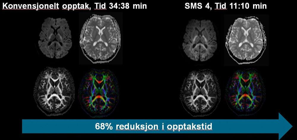 MR-snitt: Detaljert fremstilling av nervebaner i hjernen brukes blant annet til planlegging av kirurgiske inngrep i hjernen. Ved å benytte Siemens nye SMS-teknologi kan en slik fremstilling gjøres opptil 8 ganger raskere. I dette eksempelet på 11 minutter i stedet for nesten 35 minutter.  