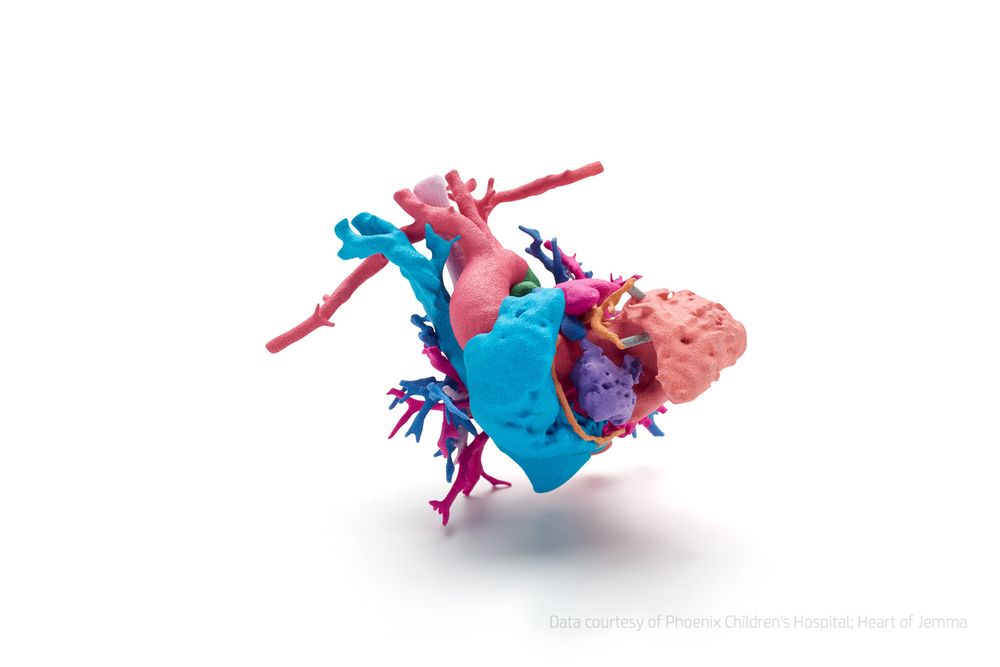 Hjertet til Jemma: Hjertet til den unge jenta Jemma, som led av en kompleks hjertefeil, ble skrevet ut i farge på basis av radiografiske 3D-bilder fra Phoenix Children’s Hospital for å forberede operasjonen og for å forklare foreldrene om tilstanden.