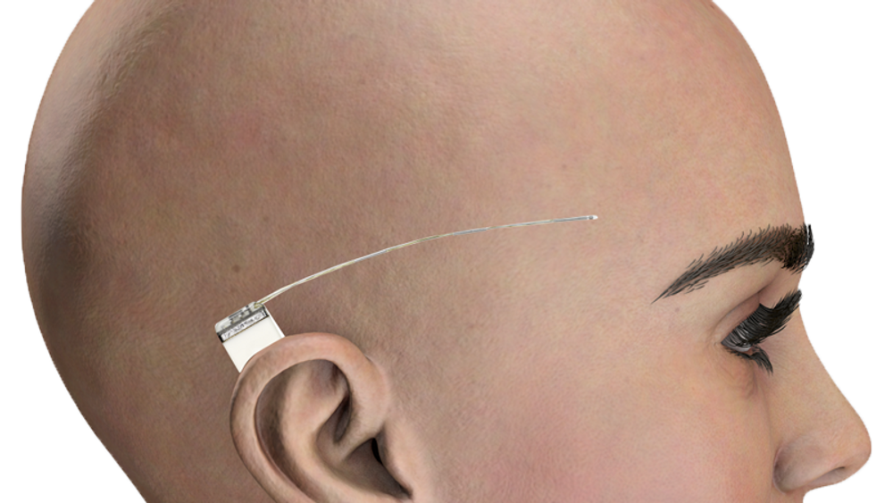 Implantatet er på størrelse med et kronestykke, og føres inn med et lite snitt bak øret.