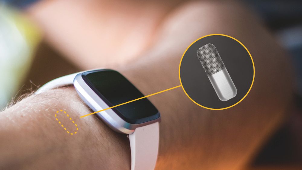 Dagens sensor fra Lifecare skal under huden ved håndleddet. Nå utvikler selskapet en variant, basert på samme prinsipp, som skal inn i bukhulen og være en del av en kunstig bukspyttkjertel.