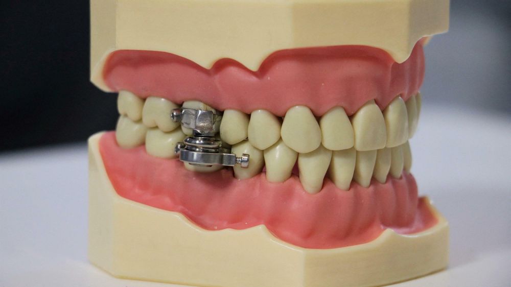 En tannlege setter bøyler på kinntennene på hver side av over- og underkjeven. Kraftige magneter er montert på bøylene, og dermed er kjeven lukket og kan bare åpnes noen få millimeter.