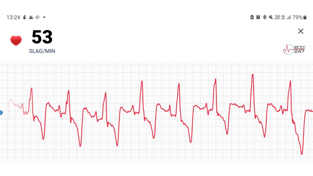 Alt vel: Mesteparten av tiden ser EKG-ene ut slik. Det betyr jevn puls og alt vel. Men skytjenesten gjør mange andre analyser som kan avsløre flere ulike typer arytmi. Slik som et betydelig antall dobbeltslag når jeg sover.
