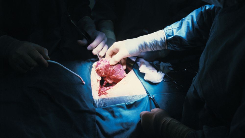 I dagens organ-transplantasjoner hentes organene fra nylig avdøde organdonorer. Om 20 til 30 år kan organene forhåpentligvis dyrkes i laboratorier. Personen på dette bildet får operert inn ny nyre på Rikshospitalet.