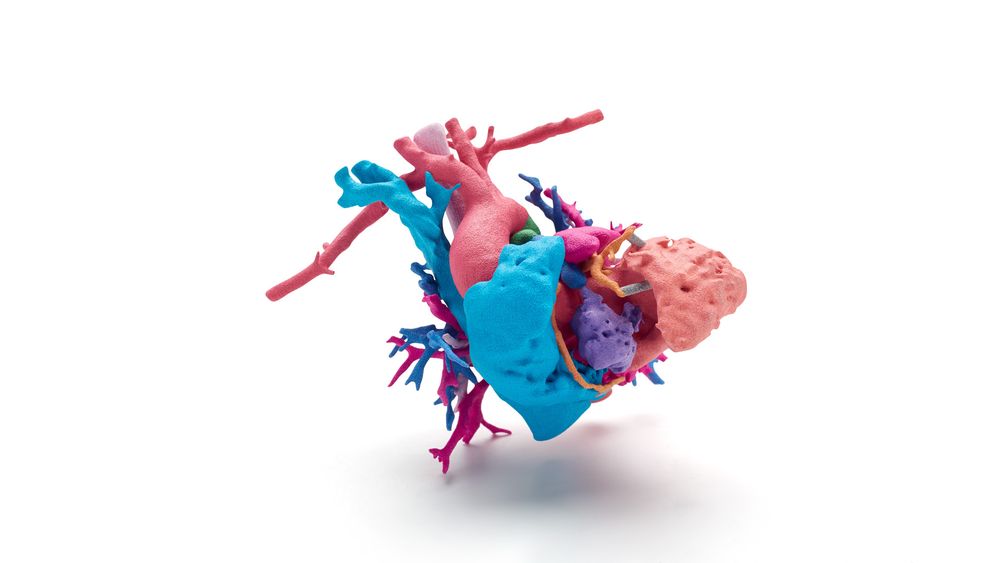 Hjertet til Jemma: Hjertet til den unge jenta Jemma, som led av en kompleks hjertefeil, ble skrevet ut i farge på basis av radiografiske 3D-bilder fra Phoenix Children’s Hospital for å forberede operasjonen og for å forklare foreldrene om tilstanden.