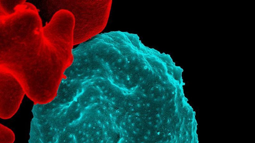 På bildet (elektronmikrografi) kan man se en rød blodcelle infisert med malariaparasitter, som er farget blå. Den infiserte cellen er øverst til venstre på bildet. Under er det en uinfisert celle med glatt rød overflate.