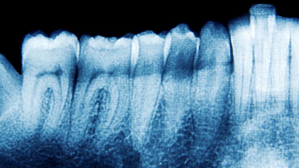 En ny studie styrker hypotesen om at tannsykdommen paradentose kan være en av årsakene til alzheimers. Nå er både en medisin og en vaksine mot paradentose i ferd med å testes ut.