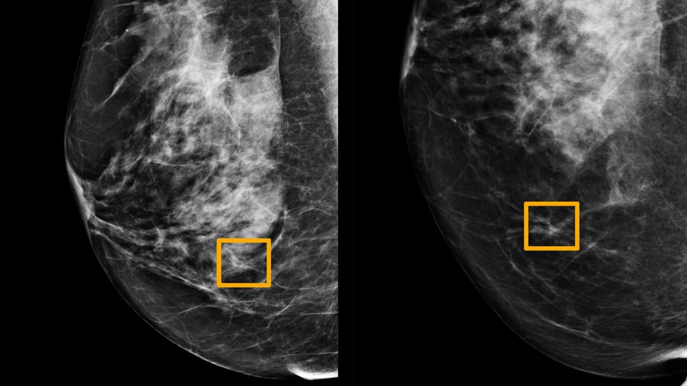 De gule boksene indikerer hvor kunstig intelligens har funnet kreftceller i brystvev.