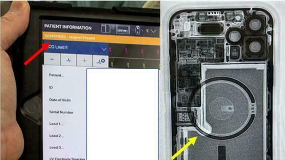 En iPhone 12 er plassert her ved siden av venstre side av brystet til en pasient med en implanterbar defibrillator, og den får defibrillatoren til å tilbakestilles og deaktiverer den.