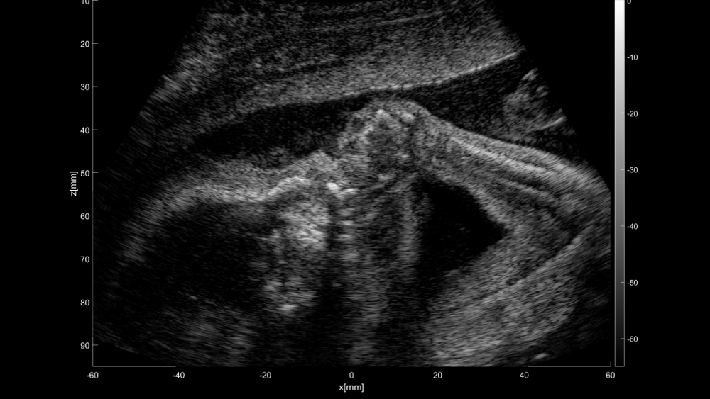 Ultralydbilde av et foster hvor ultralydsignalene er tatt opp på et GE Voluson Women's Healh Ultrasound system. Bildet er behandlet med the Ultrasound Toolbox.