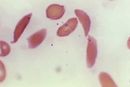 Et bilde tatt med mikroskop viser de halvmåneformede røde blodlegemene hos en pasient med sigdcellesykdom. Fredag godkjente USA to nye behandlinger for den alvorlige blodsykdommen, inkludert genterapi med såkalt crispr-teknologi.
