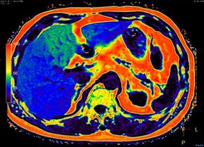 En MR-maskin kan kvantifisere mengden fett i et tverrsnitt i kroppen. Det blå og grønne området til venstre er leveren.