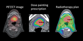 Med «dose painting» er det mulig å gi ekstra mye stråling til de mest aggressive delene av en kreftsvulst. <i>Foto: Illustrasjon</i>