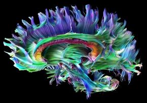 Nervebaner: En MRI-maskin med raske gradienter som den Siemens nettopp har lansert kan benytte en teknologi som kalles Diffusion Tensor Imaging og som f. eks. kan vise hvordan nervebanene i hjernen går. <i>Foto: Siemens Siemens Healthineers</i>