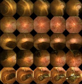 Kunstige bilder av tarmsykdommer i ulike stadier. <i>Foto:  NTNU</i>