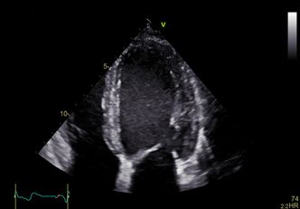 Eliteserien2D-bilde av venstre hovedkammer (øverst i bildet) og forkammer (nederst i bildet).