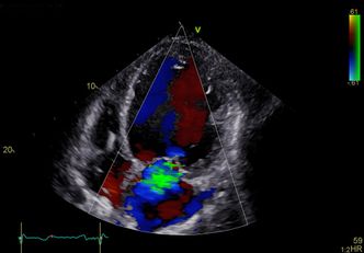 Quality from Horten2D-bilde av venstre hovedkammer (øverst i bildlet) og forkammer (nederst). Dette er et farge-doppler-bilde som viser blodstrøm fra venstre side av hjertet. Den grønne blobben viser en lekkasje i mitralklaffen, klaffen mellom venstre forkammer og hovedkammer. Her strømmer blod på grunn av lekkasje tilbake til venstre forkammer når blodet skulle vært pumpet ut gjennom aortaklaffen for å gå ut i kroppen. Lekkasjen gir redusert hjertefunksjon.
