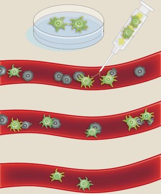 Opplæring og dyrking av immunceller i laboratorium: I laboratoriet kan immunceller få trening i å oppdage og drepe kreftceller. Spesialtrente immunceller (grønne) sprøytes inn i blodåren og går til angrep på kreftcellene (svarte). I kliniske studier har slik behandling vist seg å være effektiv mot noen typer blodkreft. Foto: Illustrasjon