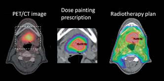 Med «dose painting» er det mulig å gi ekstra mye stråling til de mest aggressive delene av en kreftsvulst. Foto: Illustrasjon