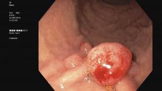 «Hvordan ser en polypp ut, og hvordan kjenner datasystemet den igjen?» Mange slike bilder av polypper mates inn i EIR-datasystemet, som så blir stadig bedre til å identifisere en polypp og andre magesykdommer. Foto: UiO