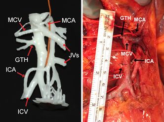 – Pasientenes karmønster i krøset er like unikt og gjenkjennbart som ansiktet deres, sier prosjektleder Dejan Ignjatovic. Bildene viser en 3D-modell laget på bakgrunn av CT-scan (t.v.), og faktisk kar som forsyner tarmen etter gjennomført operasjon (t.h.) på samme pasient. Fotokollasj: CTrue