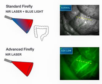 Ved å projisere lys i ulike bølgelender over organene og gi pasienten som skal opereres kontrastvæske vil kirurgen kunne se hvor svulster og blodkar er. Da kan inngrepet gjøres mer presist. Foto:  Da Vinci