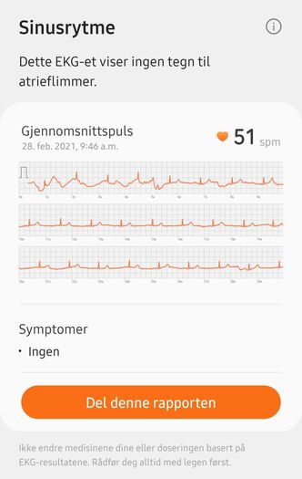 I appen: Det er grenser for hva som får plass i klokkeskjermen, men i appen får du se hele målesekvensen fra en EKG-måling Foto: Odd Richard Valmot