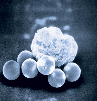 Her har Ugelstad-kuler festet seg til en kreftcelle som nå kan trekkes ut av kroppen til pasienten fordi kulene er magnetiske. Ugelstad-kulene spiller også en avgjørende rolle i moderne elektronikk og brukes i både kosmetikk og industriprodukter. Foto:  Ukjent/Sintef