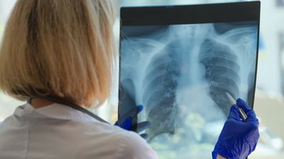 Lege med røntgenbilde av lunger.