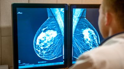 En lege studerer mammografi-bilder.