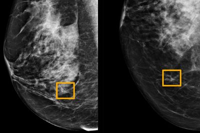 De gule boksene indikerer hvor kunstig intelligens har funnet kreftceller i brystvev.