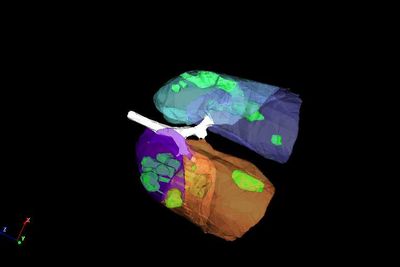 Alarm: Disse lungene er infisert av Covid-19. Det er dommen fra maskinopplært kunstig intelligens som på sekunder har analysert et CT-bilde.