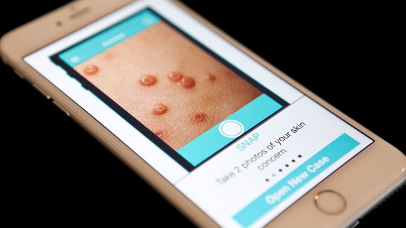 First Derm-appen lar deg sende bilder av hudtilstanden din til en hudlege, som så gir deg svar etter en viss tid.
