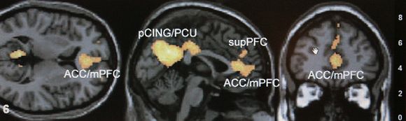 fMRI brukes i mange typer forskning. Bildet er fra en undersøkelse hvor man så på hjernene til tilhengere av ulike politiske partier, og konkluderte med at det er følelser, og ikke fornuft som drive politiske tankeprosesser.