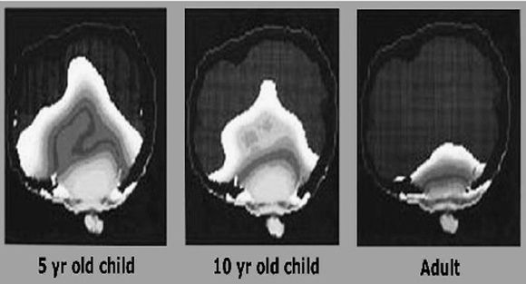 Hjerneskallen til barn er mykere enn hos voksne, og strålingen trenger derfor lenger inn. Derfor bør barn kun sende SMS, mener forskerne. (FOTO: Environmental Health Trust)