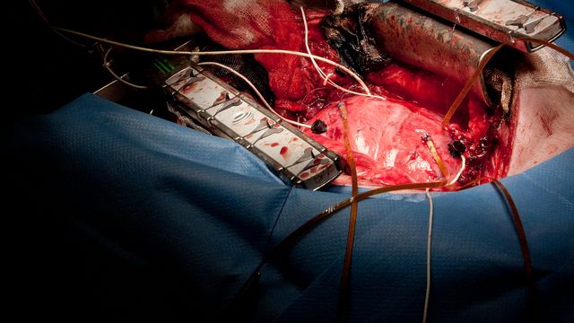 Norsk sensor kan revolusjonere hjertekirurgi 