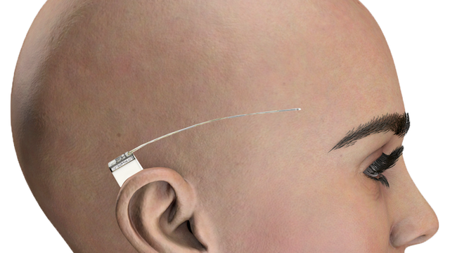 Banebrytende dansk implantat kan forhindre epilepsi-anfall