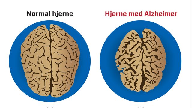 Norske forskere: Pusterytmen kan ha sammenheng med Alzheimers
