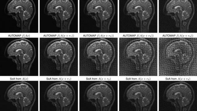 Kunstig intelligens kan «utviske» svulster i MR-skanning