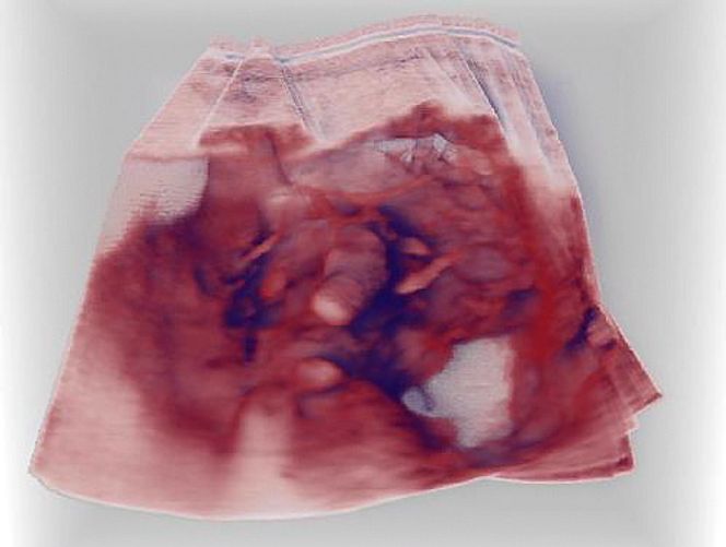 Et sammensatt 3D-volum fra en lever.