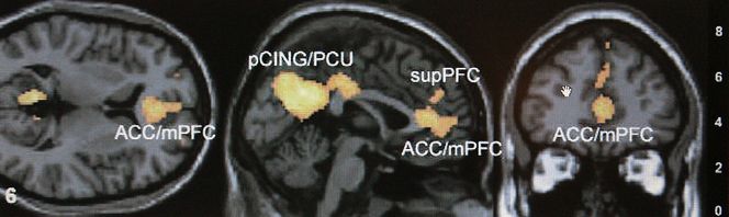 fMRI brukes i mange typer forskning. Bildet er fra en undersøkelse hvor man så på hjernene til tilhengere av ulike politiske partier, og konkluderte med at det er følelser, og ikke fornuft som drive politiske tankeprosesser.