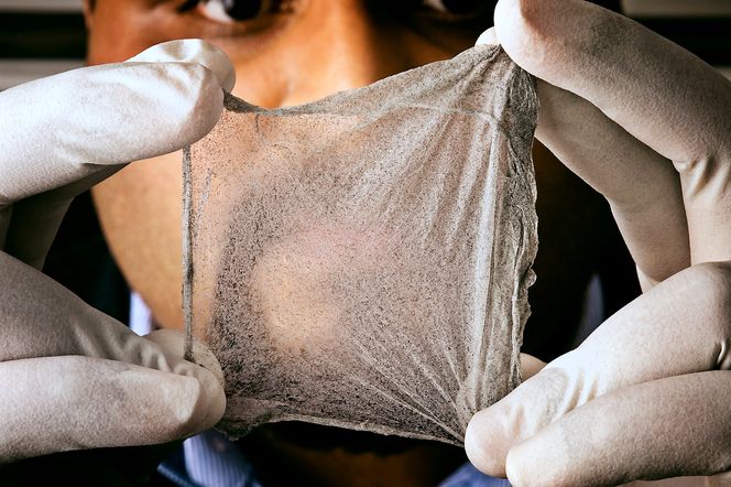 Kunstig vev: En forsker holder en «utskrift» av kunstig vev som er laget ved å printe levende celler inn i et skjelett av polymer. Teknikken som kalles «trykkassistert spinning» printer med tre nåler som er flettet inn i hverandre og som leverer celler, en tyktflytende polymer og luft. Foto: Science Photo Library